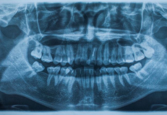 Rayos X dentales